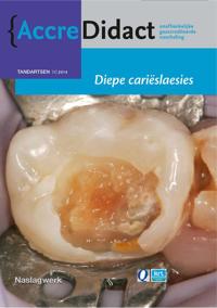 DIEPE CARIESLAESIES