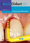 NAZORG BIJ IMPLANTATEN