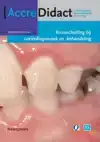 RISICOSCHATTING BIJ CARIESDIAGNOSTIEK EN -BEHANDELING GEBASE