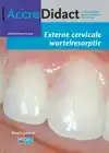 EXTERNE CERVICALE WORTELRESORPTIE