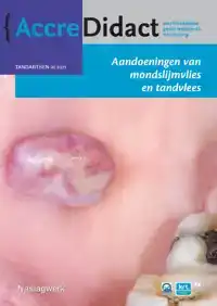 AANDOENINGEN VAN MONDSLIJMVLIES EN TANDVLEES